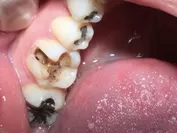 カナデ歯科　被せ物の下の虫歯