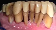 カナデ歯科　重度歯周病　参考画像