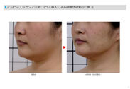 痛み・副作用の無い脂肪分解技術により小顔・顔痩せを実現！ユニッシュ、脂肪分解注射の代替法に基づくエレクトロポレーション専用導入剤を開発