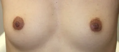 乳首治療前