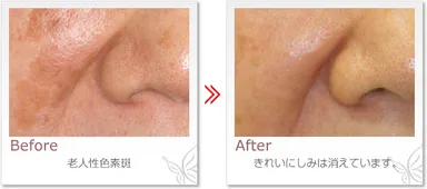 東大方式トレチノインシミ治療前後