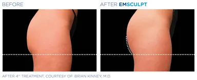 エムスカルプトヒップ症例