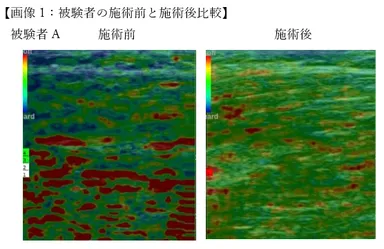 超音波エコー機器「エラストグラフィー」でも筋弛緩効果が認められています(固い筋肉＝青,バランスの良い筋肉＝緑,弱化した筋肉＝赤)