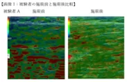 超音波エコー機器「エラストグラフィー」でも筋弛緩効果が認められています(固い筋肉＝青,バランスの良い筋肉＝緑,弱化した筋肉＝赤)