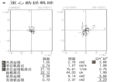 重心動揺平衡機能検査2