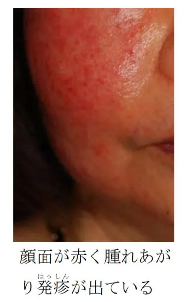 顔面からの発疹。
