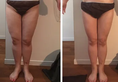 施術による肌質の変化