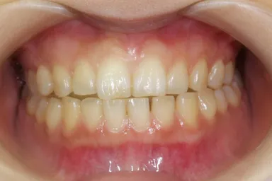 『FACE TALKホワイトニング』施術前