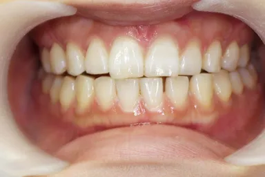 『FACE TALKホワイトニング』施術後