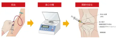 PRP療法イメージ