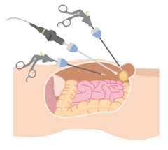 鼠径ヘルニア腹腔鏡手術