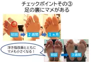 浮き指チェックポイント(3)