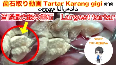 当院最大級の歯石。1日で100万再生を記録！！