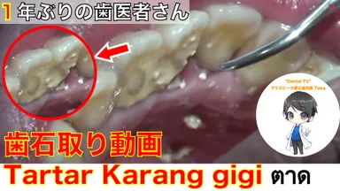 1年でも歯石が溜まります。日々の歯磨き大切です！！