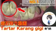 世界No1動画再生数の歯石取り動画！！