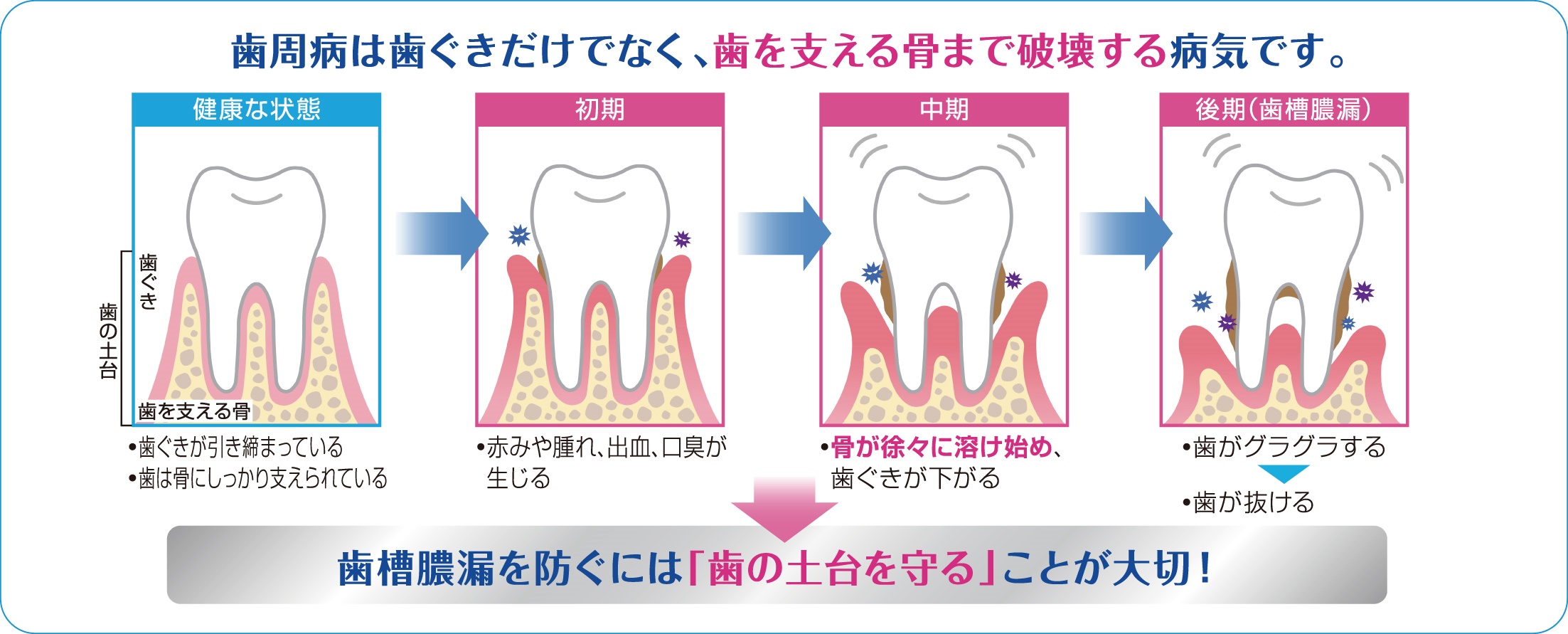 膿 漏 歯槽