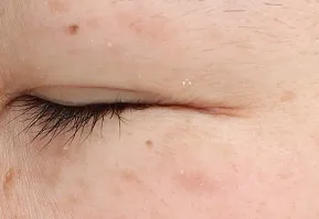 目尻のシワの変化