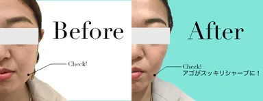 ハイフ・ビフォーアフター