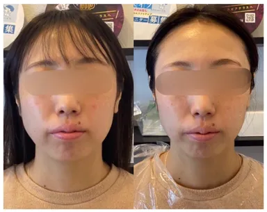 糸リフト・ビフォーアフター