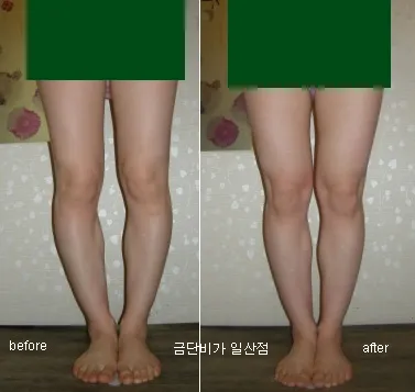施術前・後
