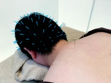 首肩周りにも刺鍼します