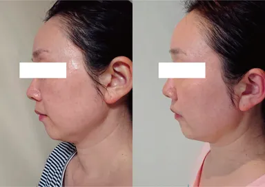 ムクミ・フェイスラインのタルミが軽減