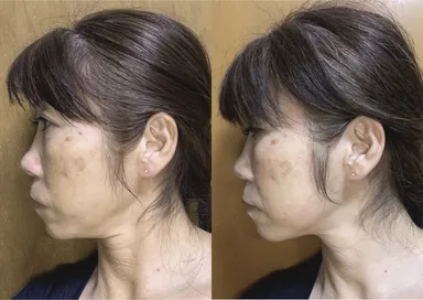 シミ・フェイスラインのタルミ・くすみが軽減