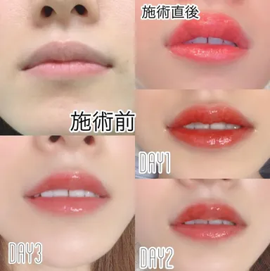 リップアートメイクの施術経過(1)