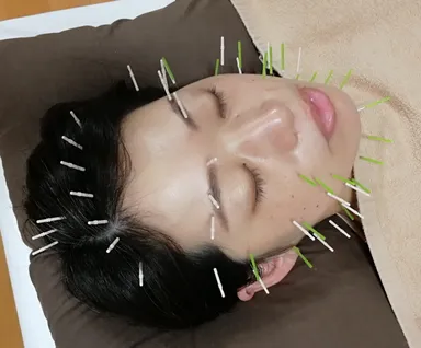 恋のサクラ美鍼