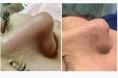 毛穴汚れが浮き出てきます！