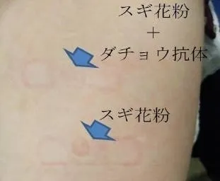 花粉症の人へのパッチテスト