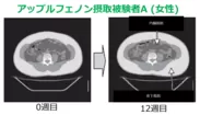 内臓脂肪の減少(CT画像)