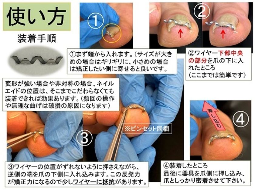 専門医師が開発した巻き爪矯正器具 ネイルエイド で2万人以上の 巻き爪難民 を救済 10人に1人が悩んでいる 巻き爪 治療費は自費負担で高額 合同会社ひまわりコーポレーション のプレスリリース