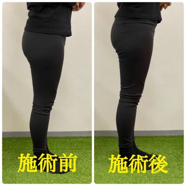 ヒップライン側面