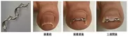 医師が開発した巻き爪矯正器具「ネイル・エイド」と使用例