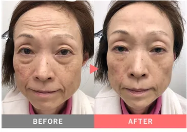 目元、おでこ、ほうれい線等、部分的に使えます※メーキャップ効果