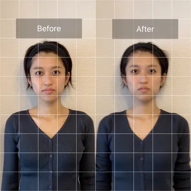 30代女性　1回施術　前向き