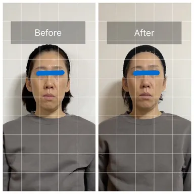 50代女性　1回施術　前向き