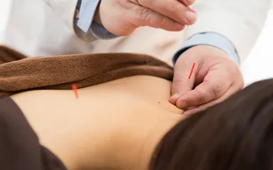 日本の鍼治療は細い鍼を使う