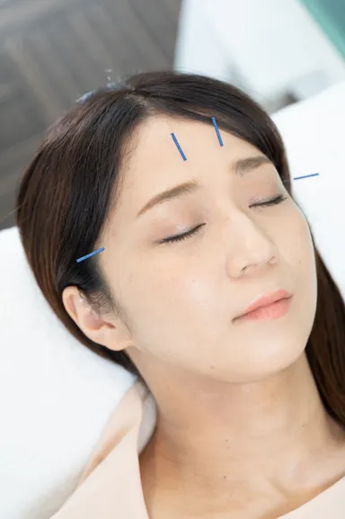 はりをした写真