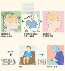 深部電極留置術