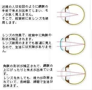 近視治療効果のメカニズム