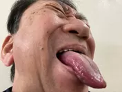 舌痛症