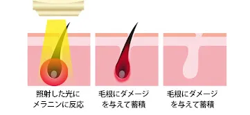 フォトフェイシャル効果も期待できるIPL