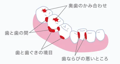 歯垢が残りやすい部分