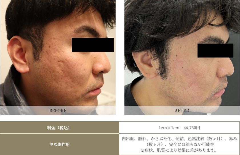 ニキビ跡の治療に効果はあるのでしょうか?