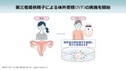 第三者提供精子による体外受精(IVF)の実施