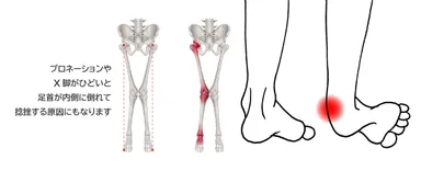 踵のあたりやX脚
