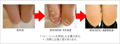 「ベビーフット」を使用した足裏の変化
