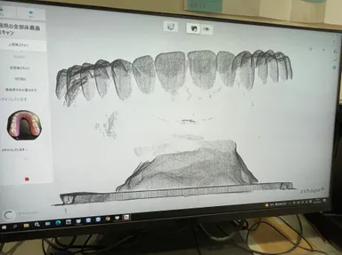 入れ歯の形状をデータ処理中